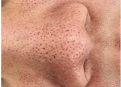 Enlarged Pores skin concern