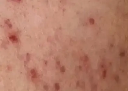Acne Marks skin concern