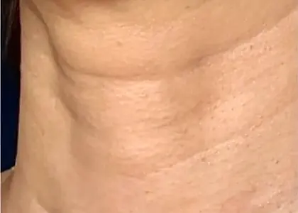 Neck Texture skin concern