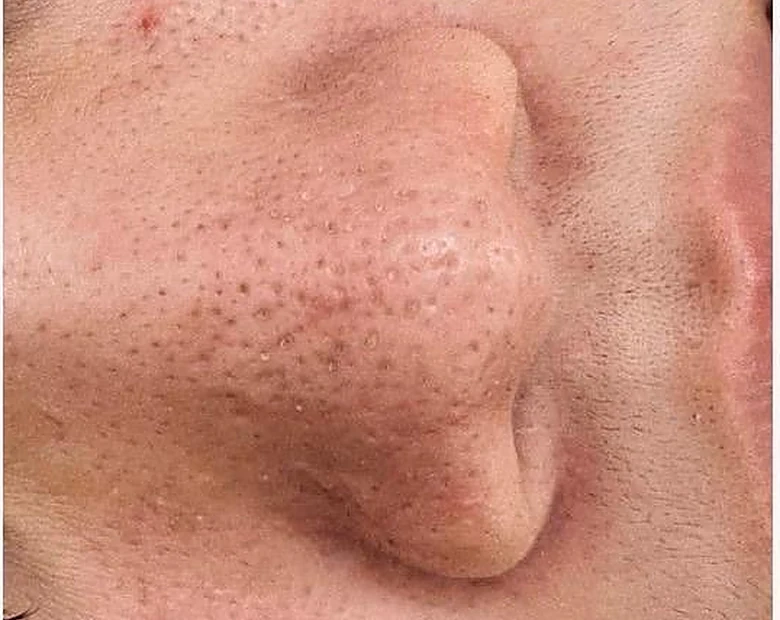 After: Enlarged Pores treatment example at BeautyFull Medispa
