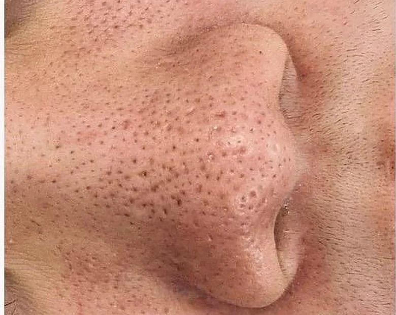 Before: Enlarged Pores treatment example at BeautyFull Medispa