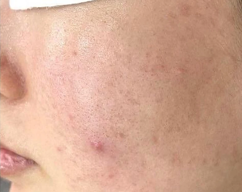 After: Acne-Prone Skin treatment example at BeautyFull Medispa