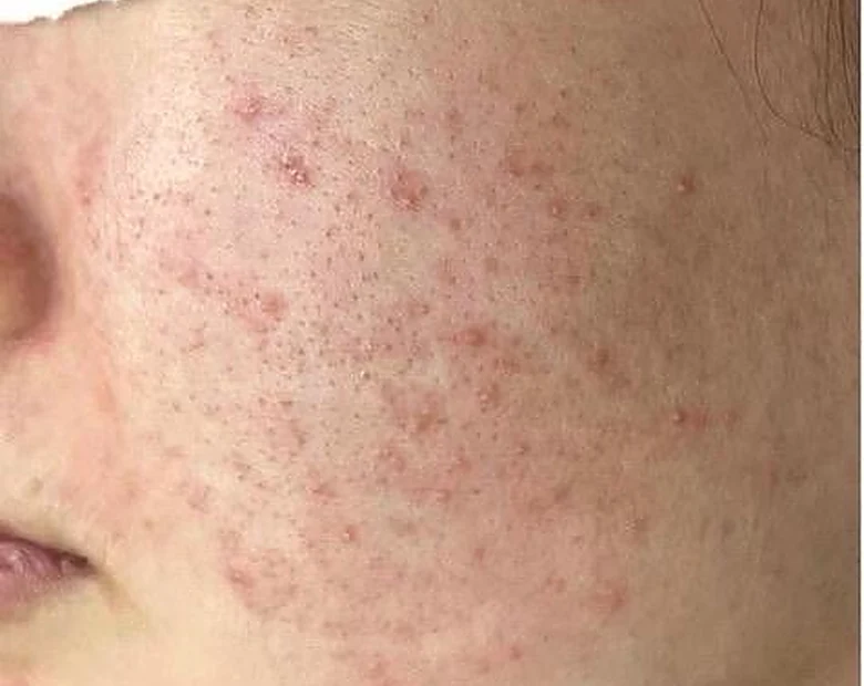 Before: Acne-Prone Skin treatment example at BeautyFull Medispa