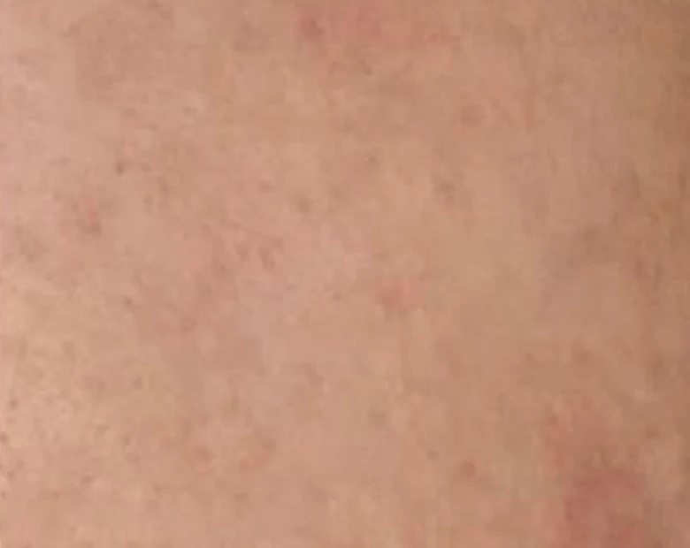 After: Acne Marks treatment example at BeautyFull Medispa