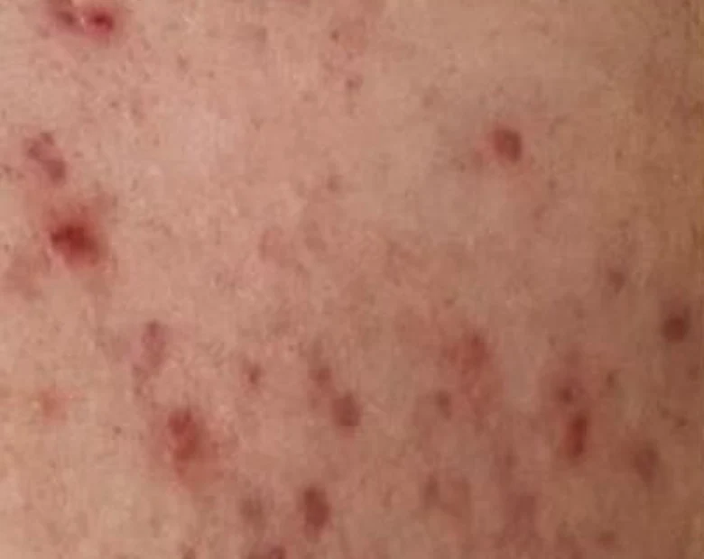 Before: Acne Marks treatment example at BeautyFull Medispa