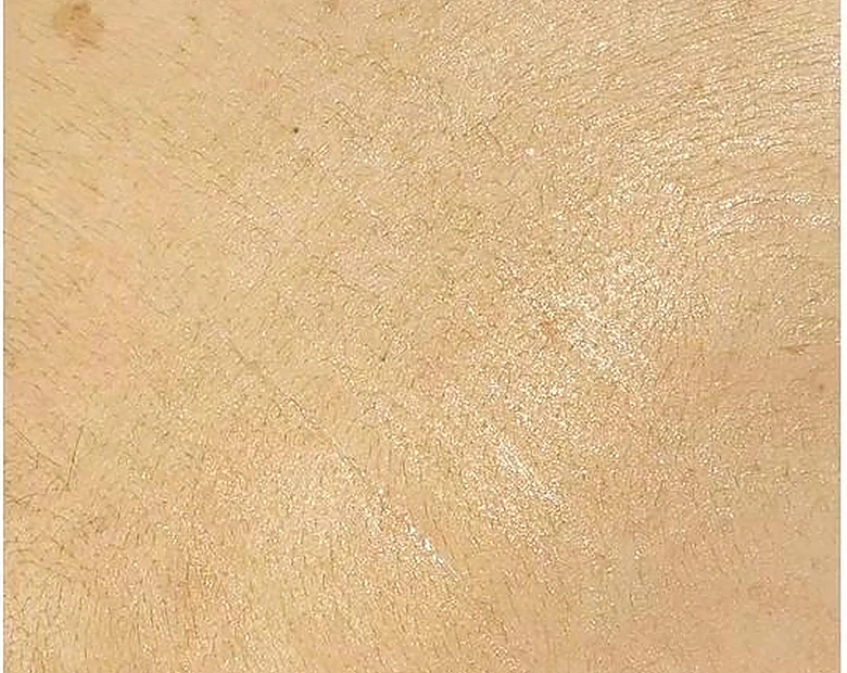 After: Body Texture treatment example at BeautyFull Medispa