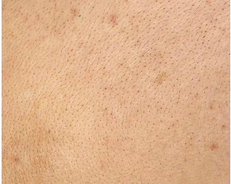 Before: Body Texture treatment example at BeautyFull Medispa