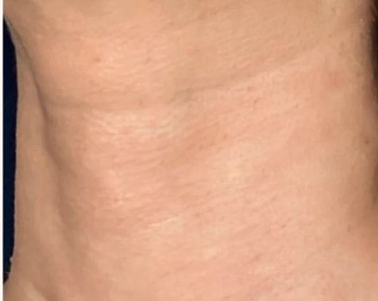 After: Neck Texture treatment example at BeautyFull Medispa