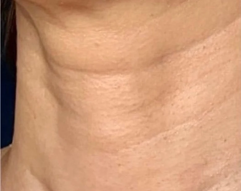Before: Neck Texture treatment example at BeautyFull Medispa