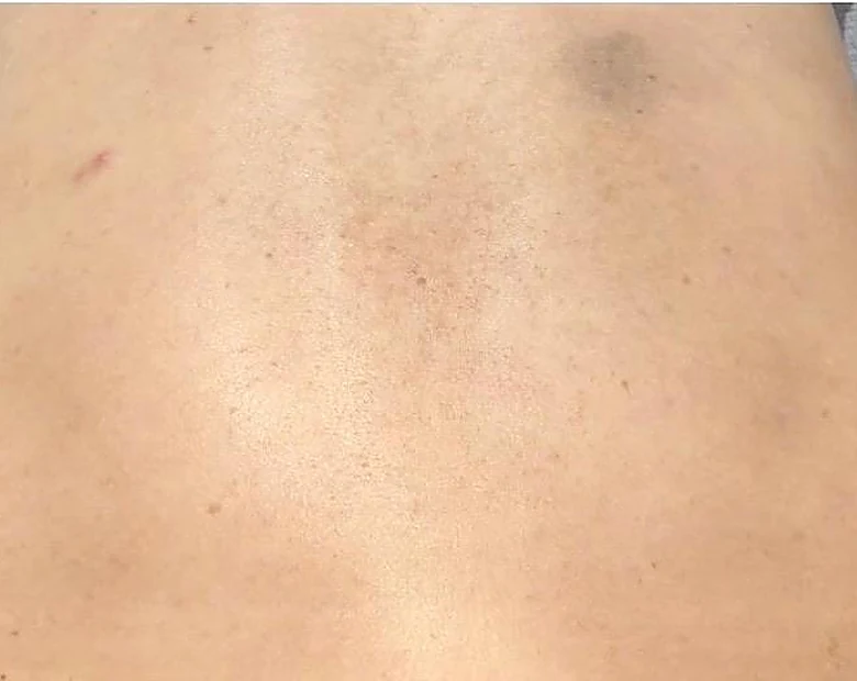 After: Back Congestion treatment example at BeautyFull Medispa