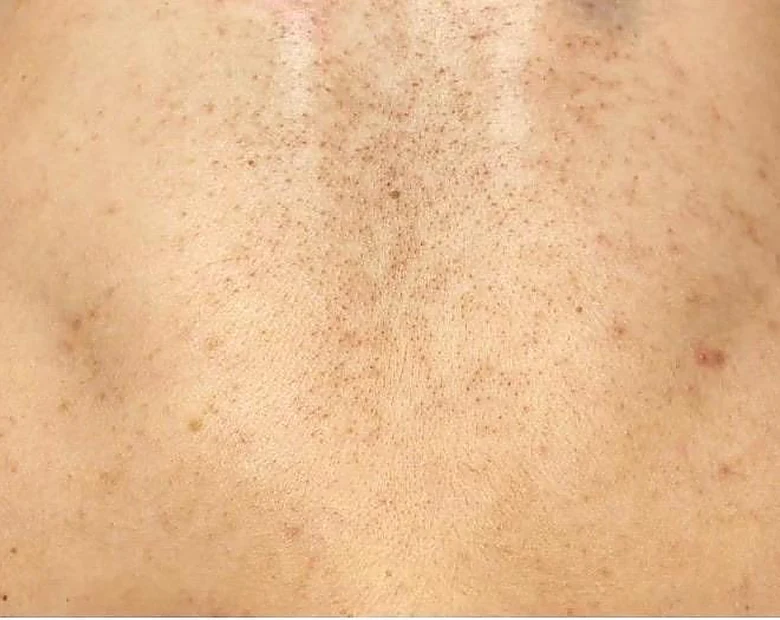 Before: Back Congestion treatment example at BeautyFull Medispa
